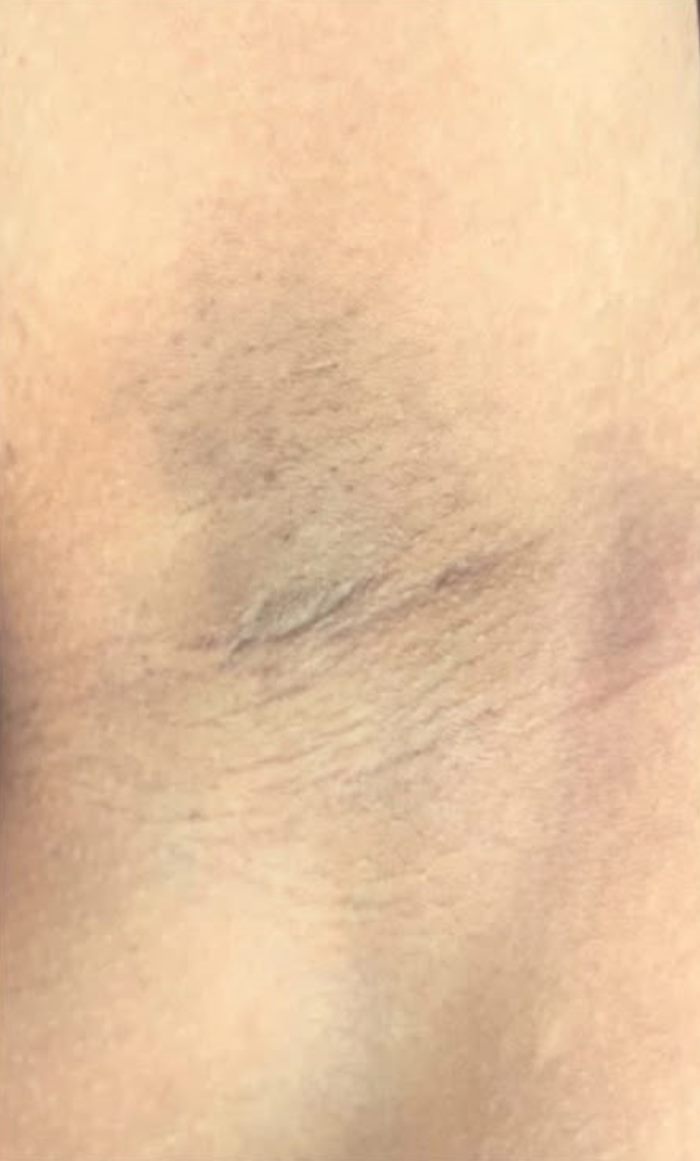 护理后